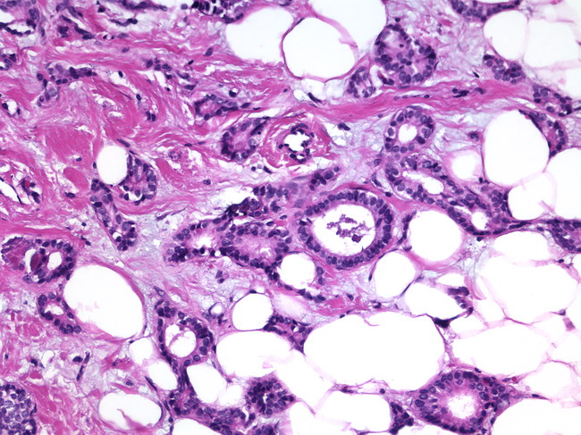 Breast_TubularCarcinoma2.jpg