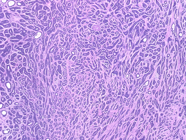 Cervix_AdenoidCysticCarcinoma1.jpg