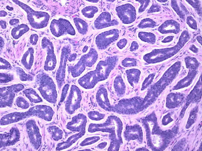 Cervix_AdenoidCysticCarcinoma2.jpg