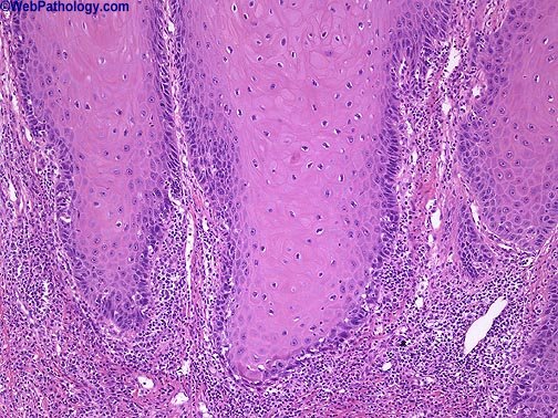 Pediatric Head And Neck Squamous Cell Carcinoma