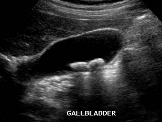 GallBladder_Radiology1_resized.jpg