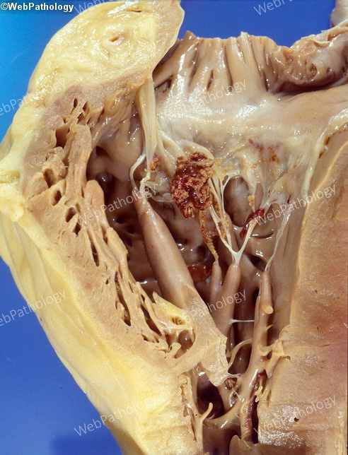 Heart_InfectiveEndocarditis1A.jpg