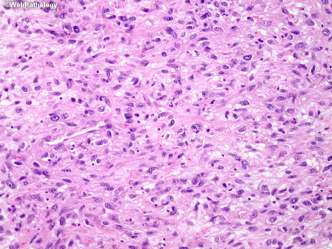 Heart_Tumors_Myxofibrosarcoma3.jpg