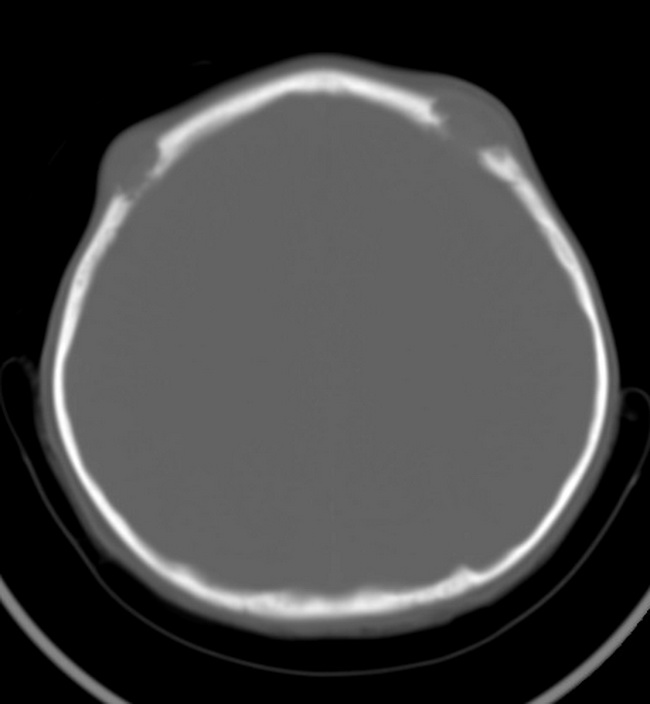 HemPath_LCH_Radiology3-resized.jpg