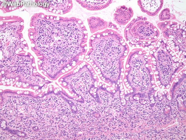 HemePath_HistiocyticSarcoma15.jpg