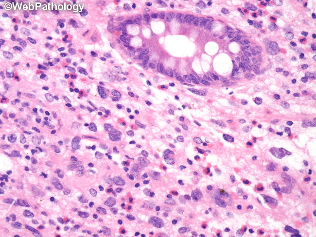 HemePath_HistiocyticSarcoma16.jpg