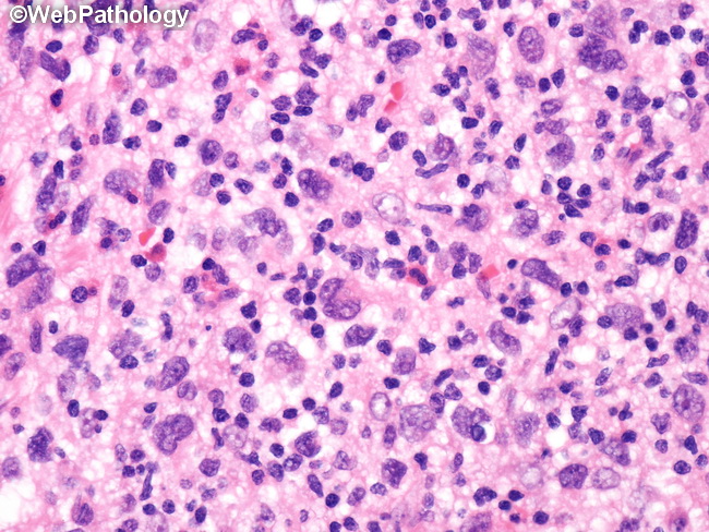 HemePath_HistiocyticSarcoma19.jpg