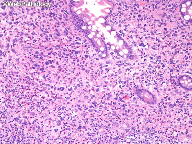 HemePath_HistiocyticSarcoma21.jpg