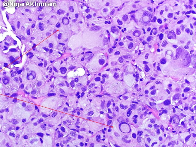 HemePath_HistiocyticSarcoma25_resized.jpg