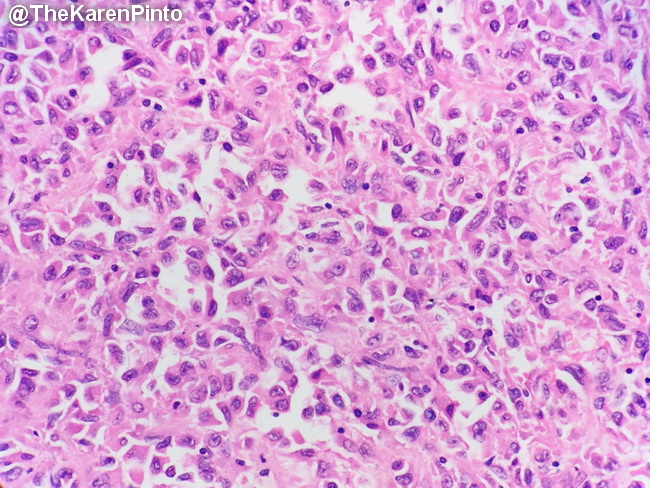 HemePath_HistiocyticSarcoma27_resized.jpg