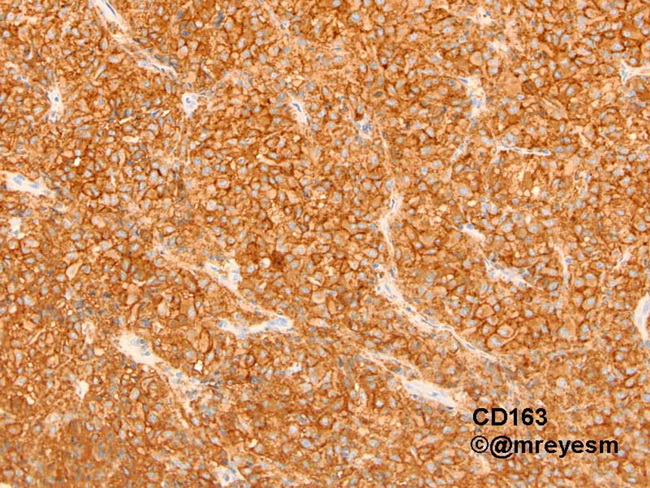 HemePath_HistiocyticSarcoma28_resized.jpg