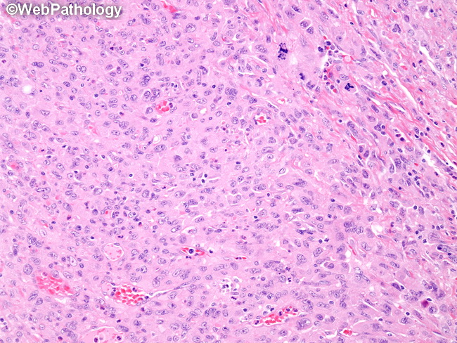HemePath_HistiocyticSarcoma3.jpg