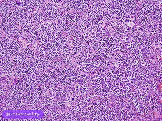 HemePath_MyeloidSarcoma_Megakaryocytic1_resized.jpg