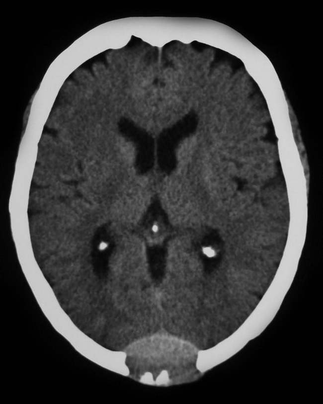 HemePath_MyeloidSarcoma_Radiology3_resized.jpg