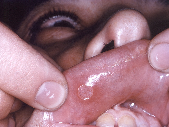 HerpesVirus_15_CDC.jpg