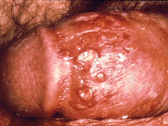 InfectiousDz_Herpes_Genital_CDC_resized.jpg