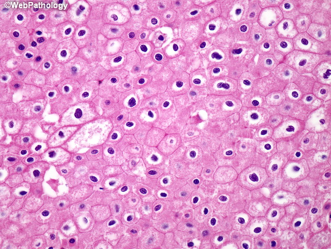 Kidney_ChromophobeRCC12.jpg