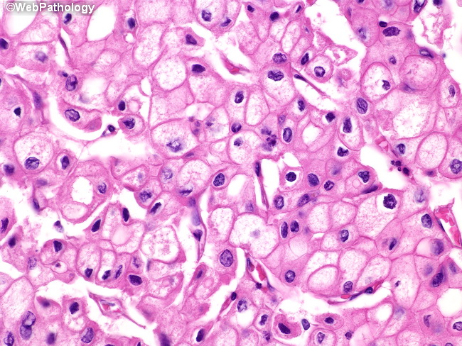 Kidney_ChromophobeRCC3.jpg
