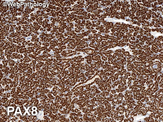 Kidney_MetanephricAdenoma42_PAX8_resized(1).jpg