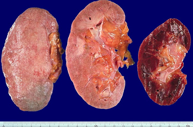 Kidney_MultipleMyeloma_Gross1_Resized.jpg