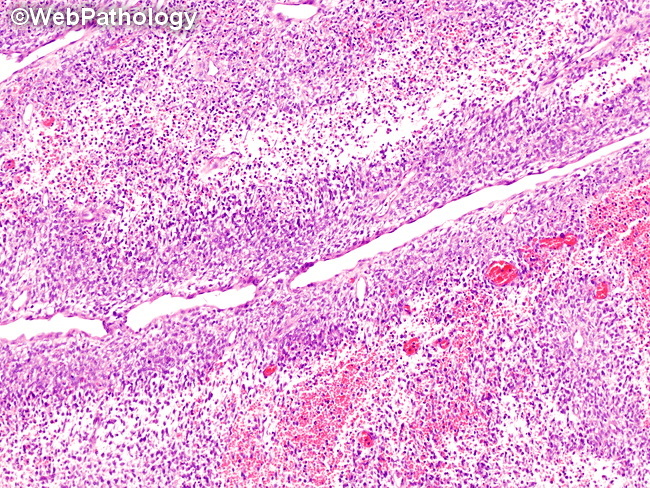 Kidney_Pediatric_CMN24_Cellular_Hemorrhage_Necrosis1.jpg