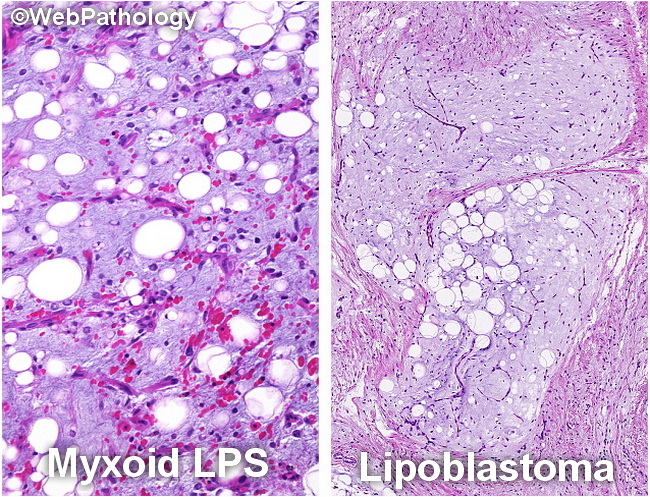 Lipoblastoma_Differential_Composite_resized.jpg