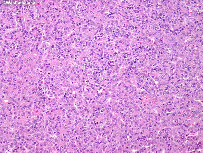 Liver_Hepatoblastoma14_Fetal.jpg