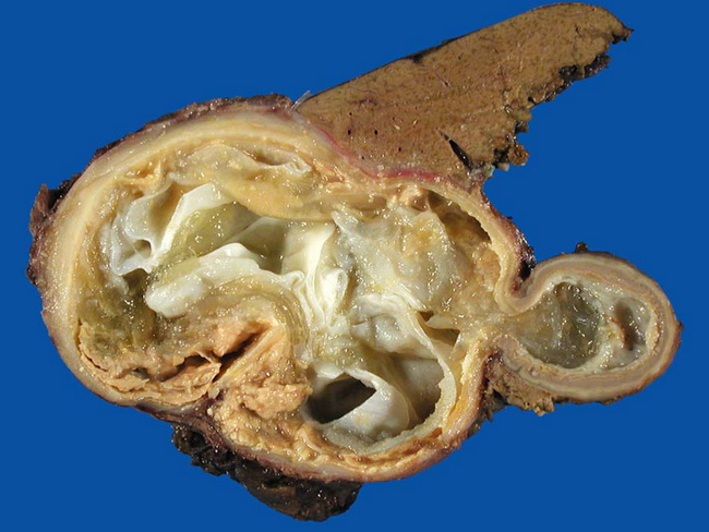 Liver_Infections_EchinococcalCyst2(1).jpg