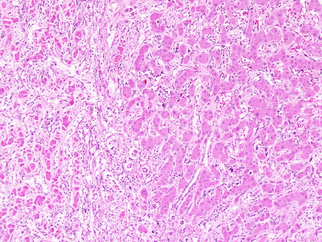 Liver_Vascular_Angiosarcoma1A.jpg