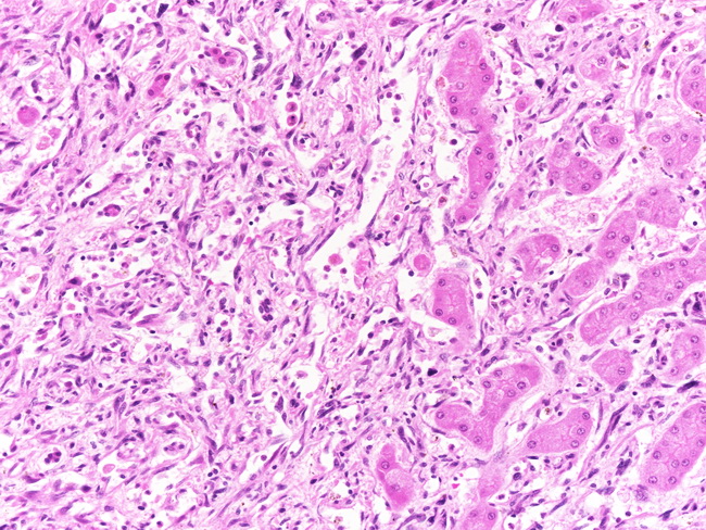 Liver_Vascular_Angiosarcoma1C.jpg