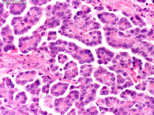 Lung_Mesothelioma18_TubuloPapillary.jpg