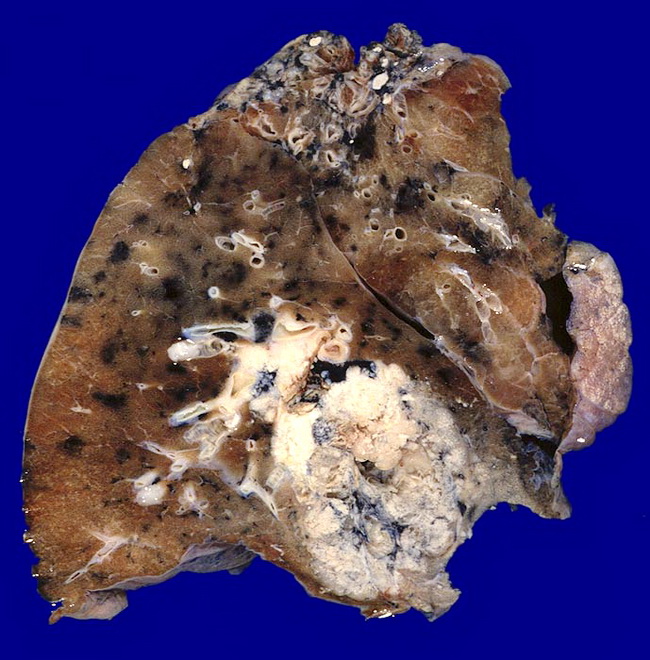 Lung_Neoplastic_SCC_Gross2_Resized.jpg