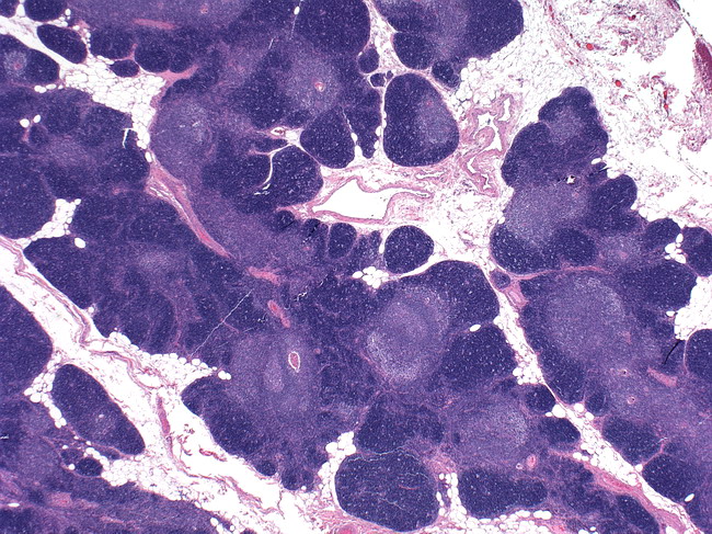 Thymic Follicular Hyperplasia Thymus Histology