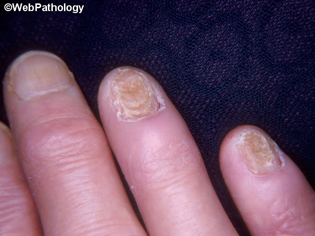 Nails_Dystrophy1_Diabetes.jpg