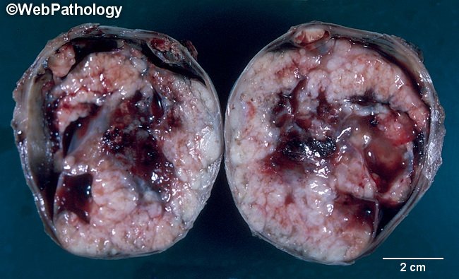 Ovary_ClearCellCarcinoma_Gross1_cropped.jpg