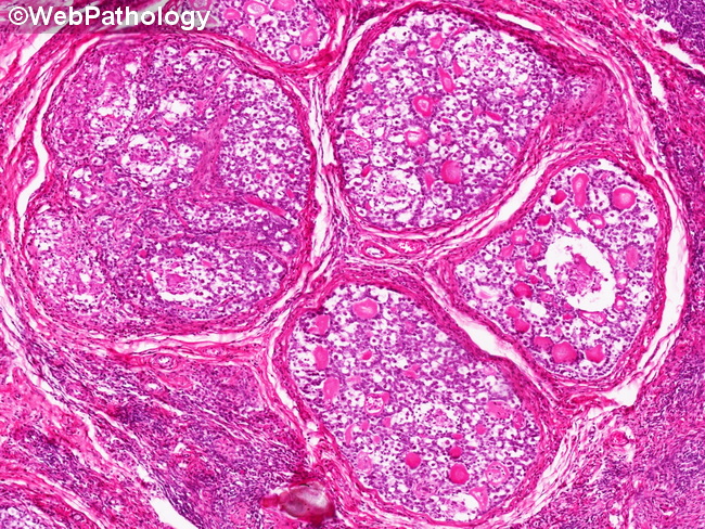 Ovary_GermCellTumors_Gonadoblastoma36.jpg