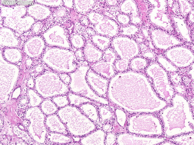 Pancreas_MicrocysticCystadenoma11(1).jpg