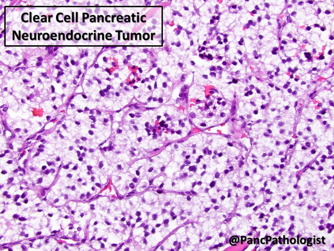 Pancreas_PanNET123_ClearCell_resized.jpg