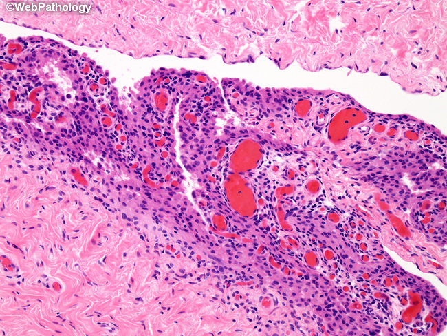 Peritoneum_MesothelialHyperplasia12_Hydrocele.jpg