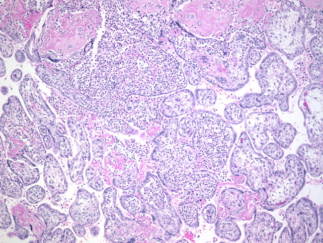 Placenta_AcuteVillitis1.jpg