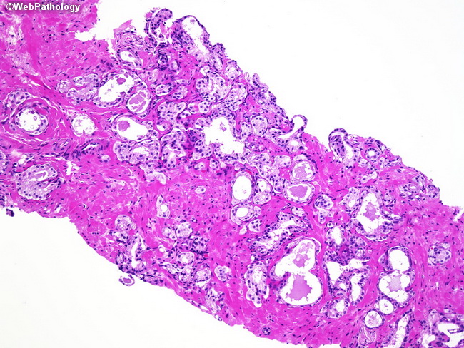 Inverted papilloma nasal pathology outlines