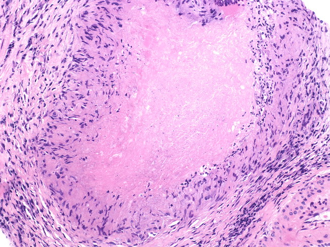 Prostate_Inflammation_NecrotizingGranuloma.jpg