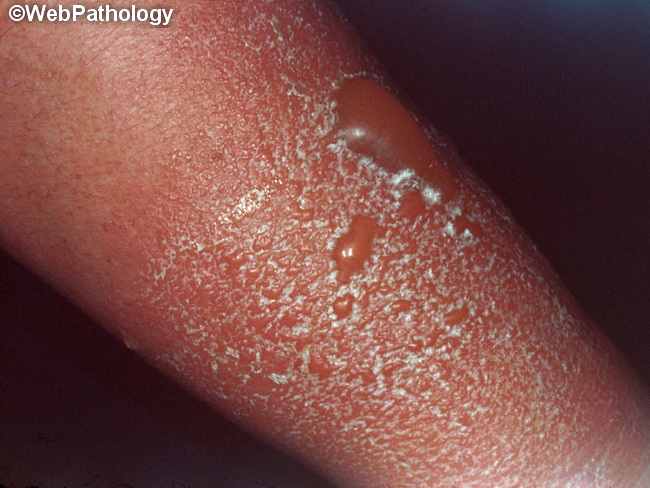 Skin_Dermatitis_Mercury.jpg