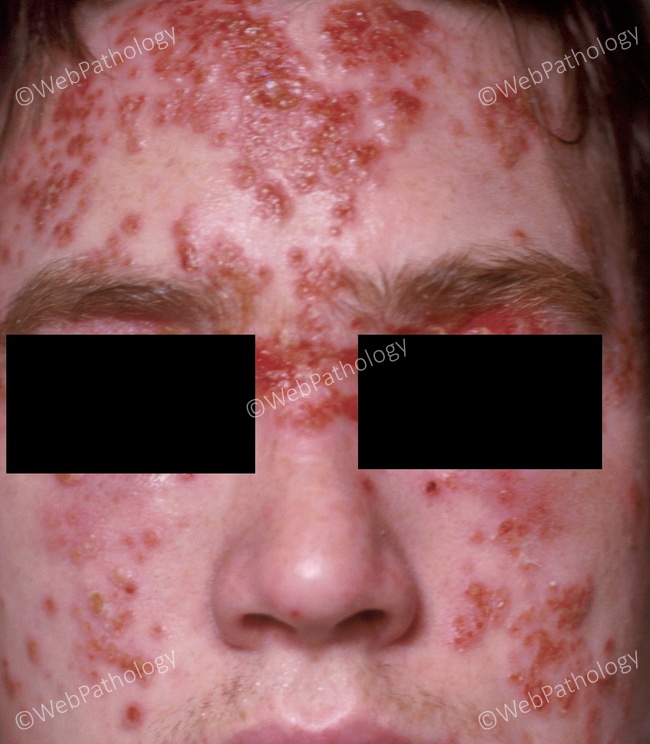 Skin_HerpesSimplex_KaposiVaricelliformEruption_cropped2B.jpg
