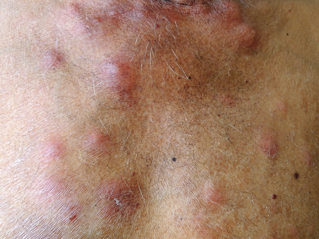 Skin_Infections_Leprosy1_resized.jpg
