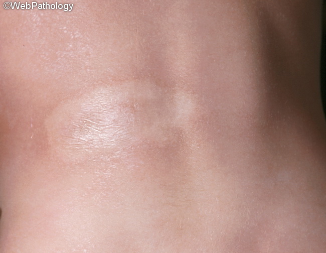 Skin_Scleroderma15.jpg