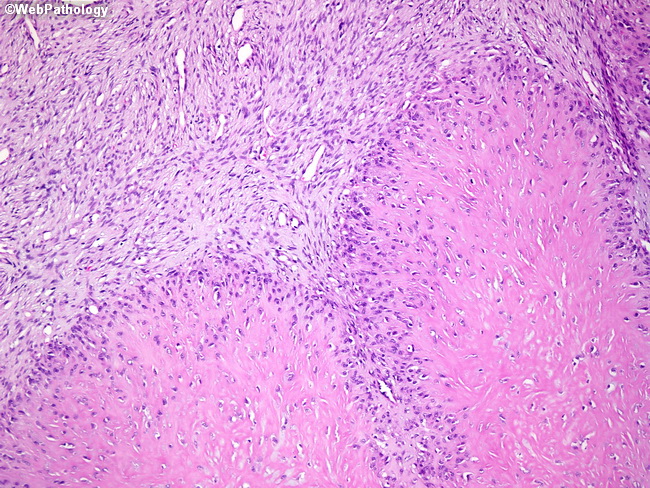 spindle cell neoplasm