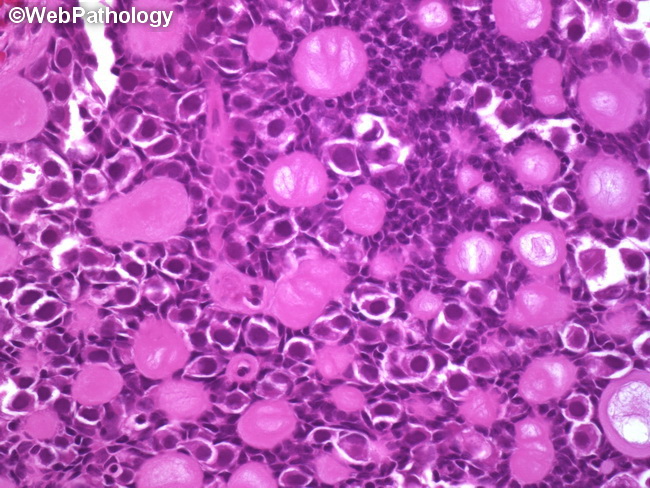 Testis_Gonadoblastoma4(1).jpg