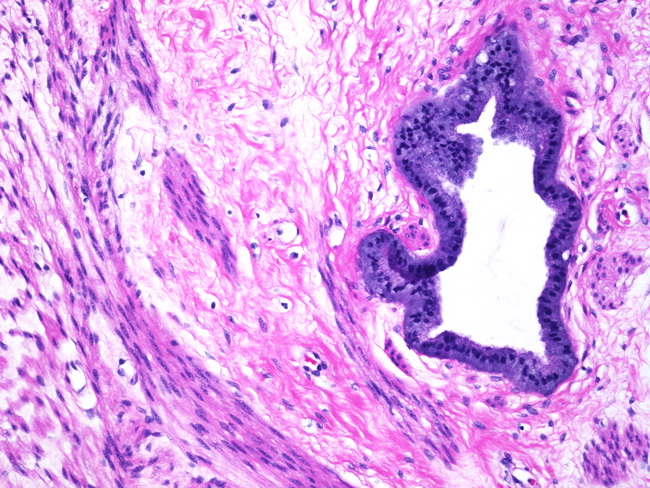 Uterus_EndocervicalAdenomyoma2.jpg