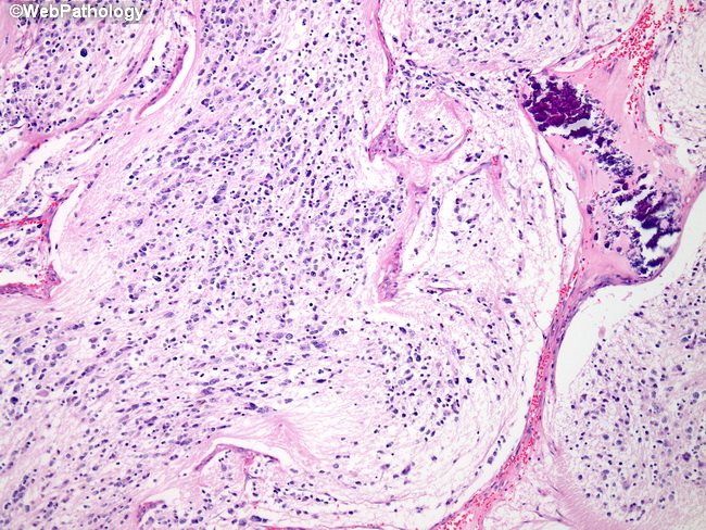 Adrenal_Neuroblastoma36.jpg